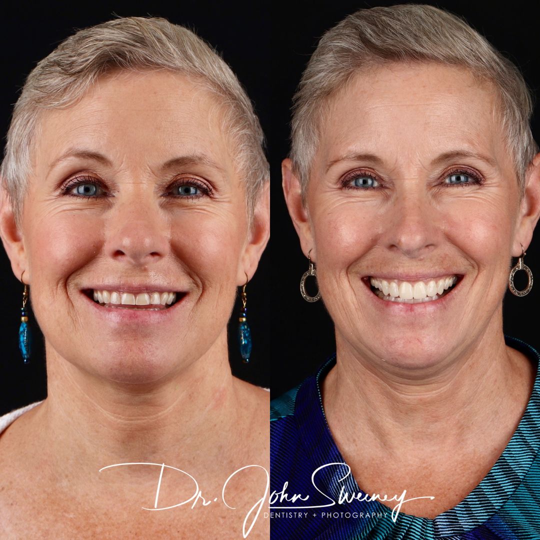 Before and After Image - Slideshow