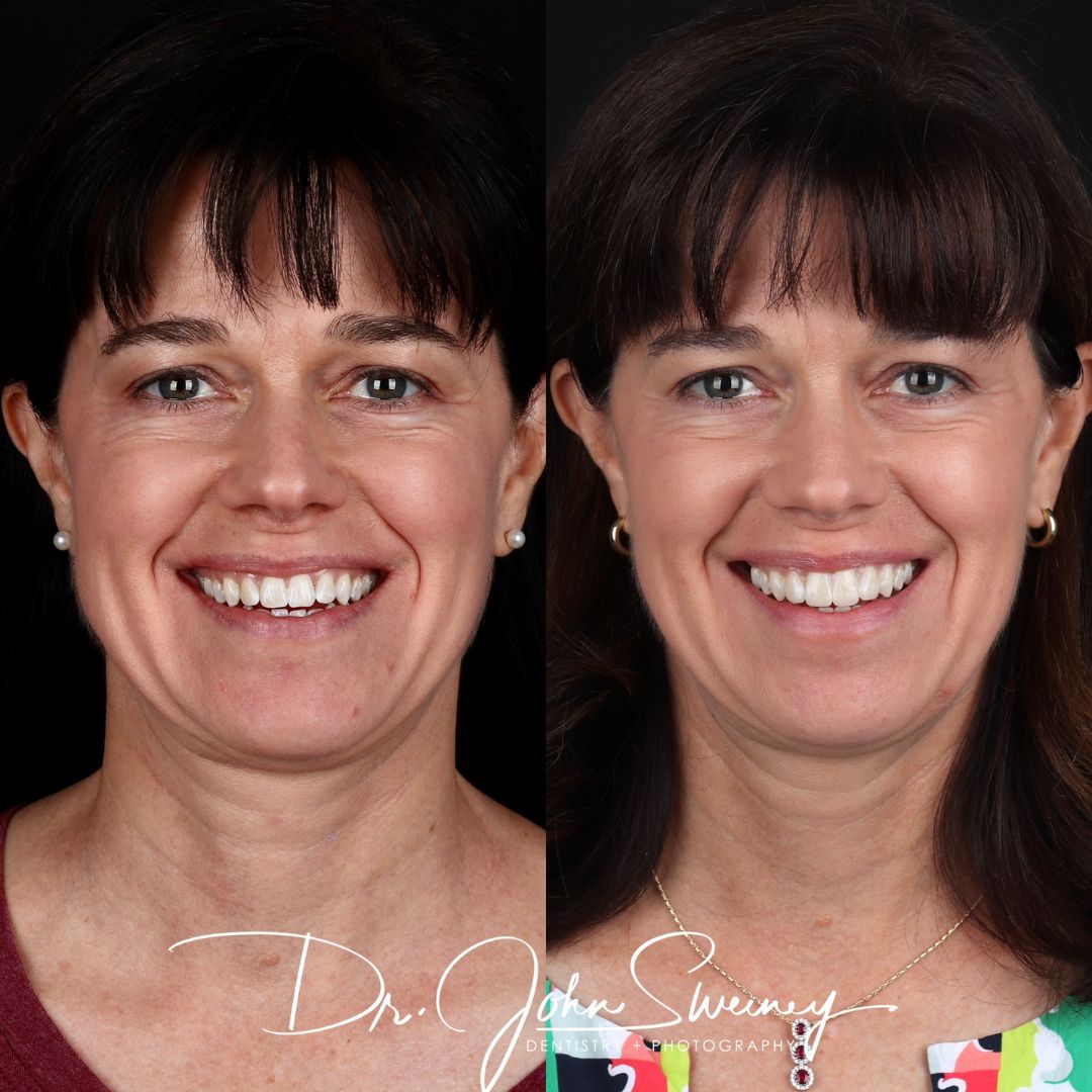 Before and After Image - Slideshow