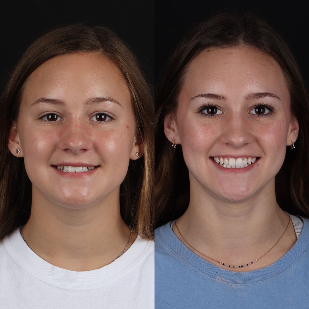 Before and After Image - Slideshow