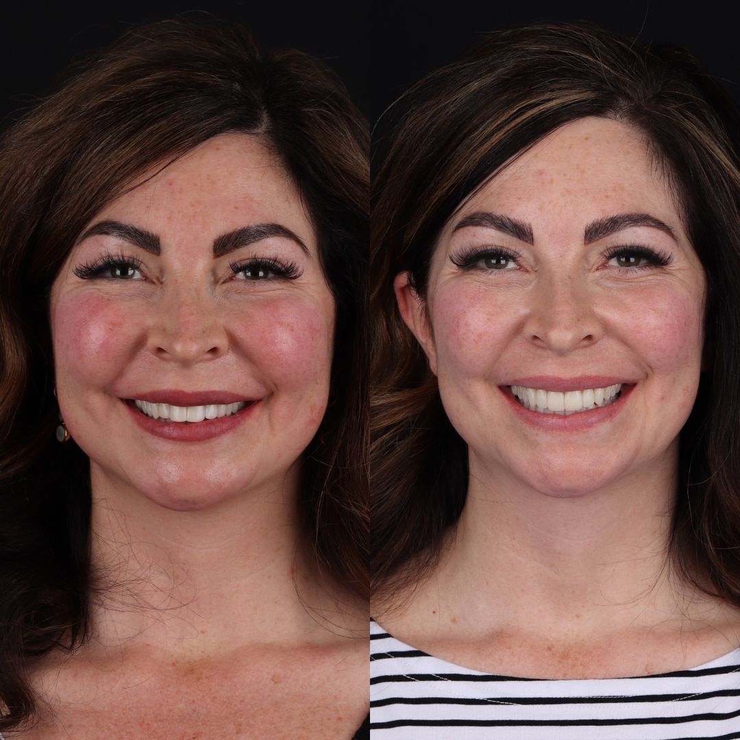 Before and After Image - Slideshow