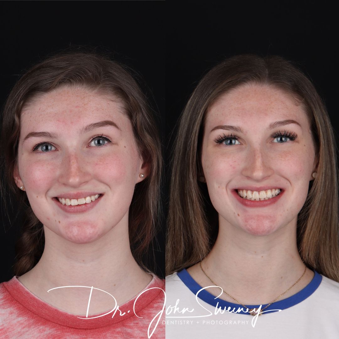 Before and After Image - Slideshow