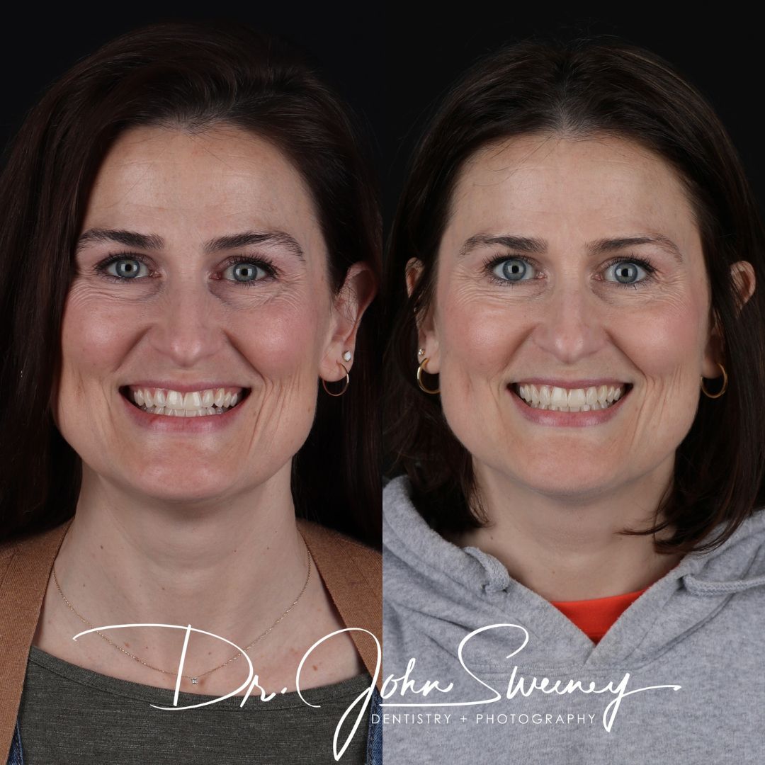 Before and After Image - Slideshow