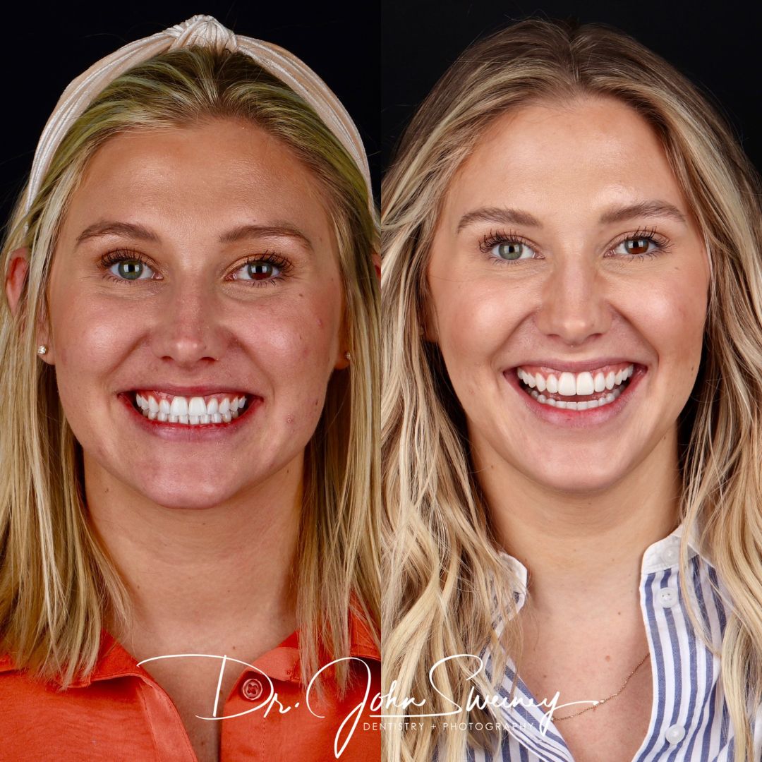 Before and After Image - Slideshow