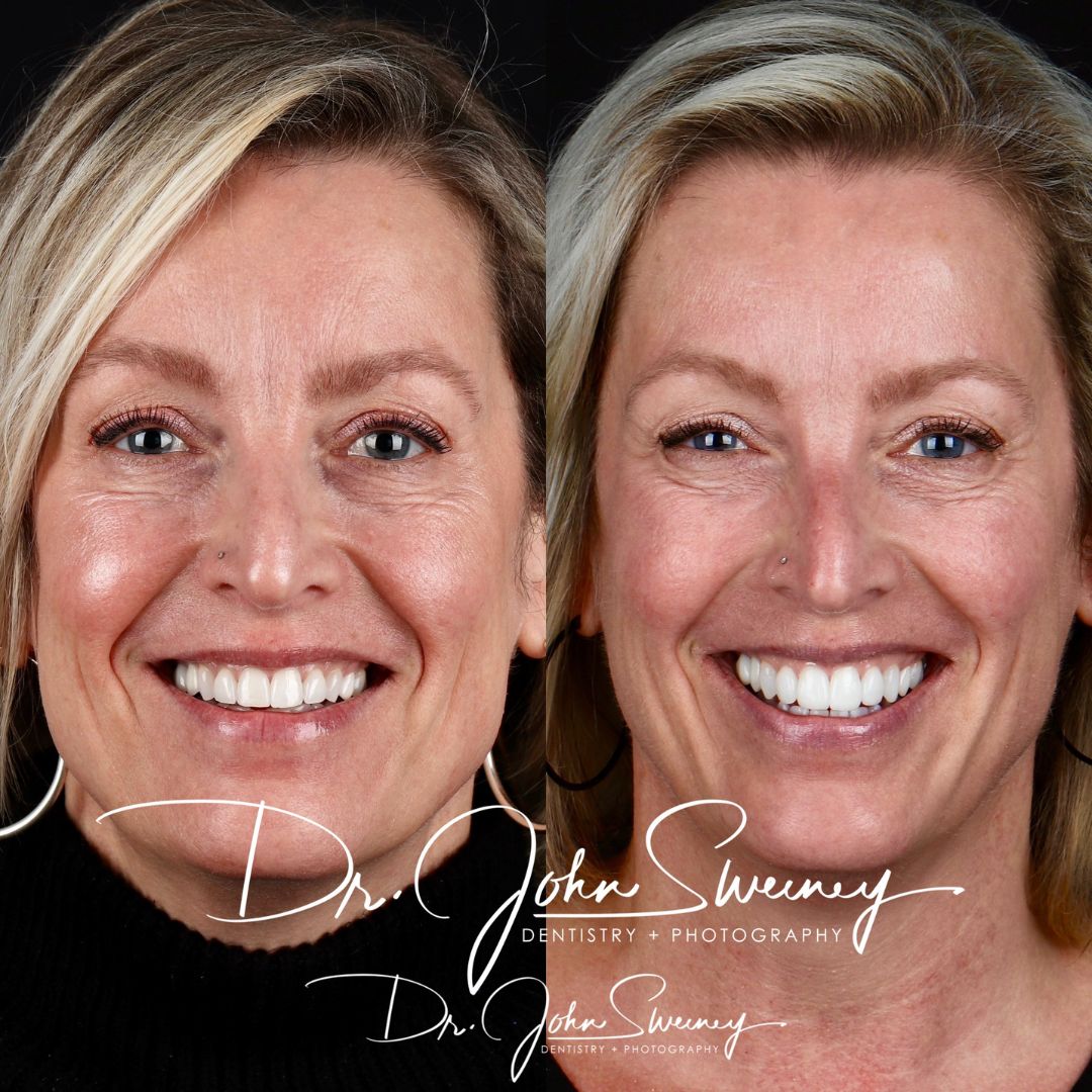 Before and After Image - Slideshow
