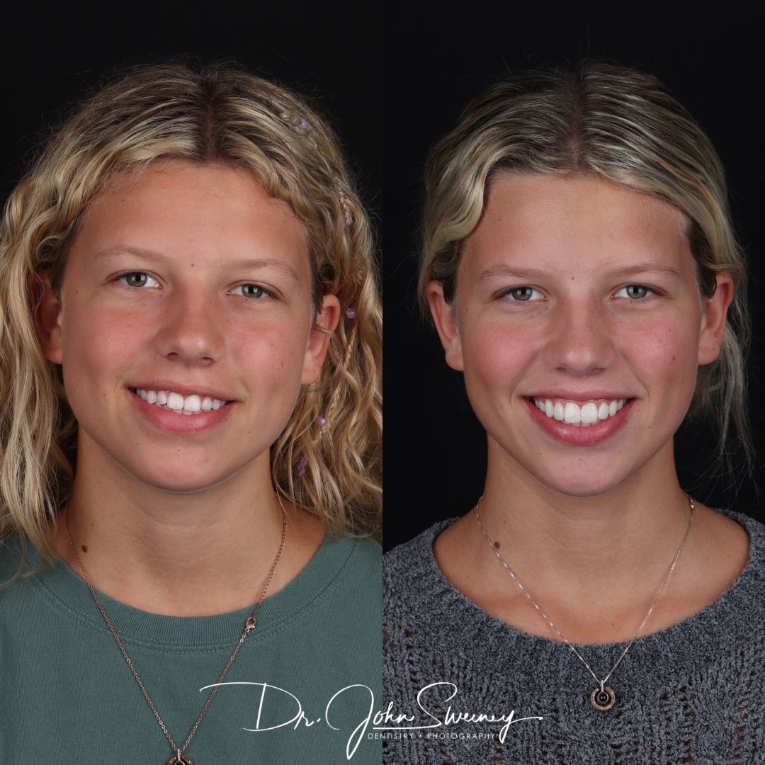 Before and After Image - Slideshow