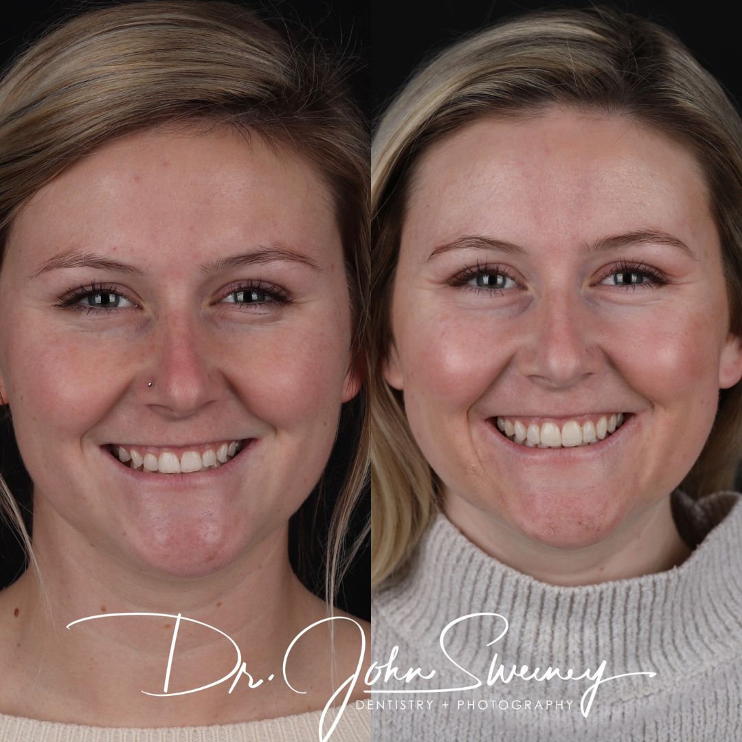 Before and After Image - Slideshow