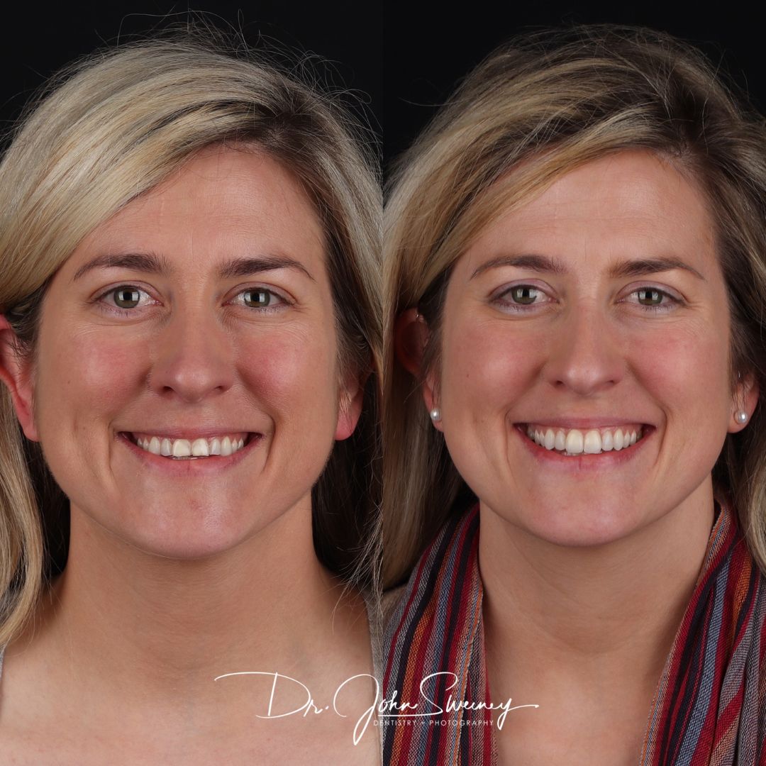 Before and After Image - Slideshow
