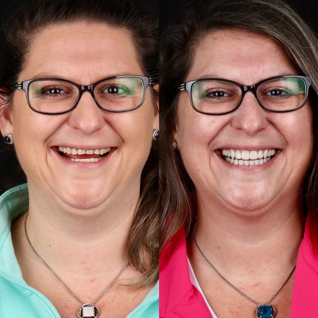 Before and After Image - Slideshow