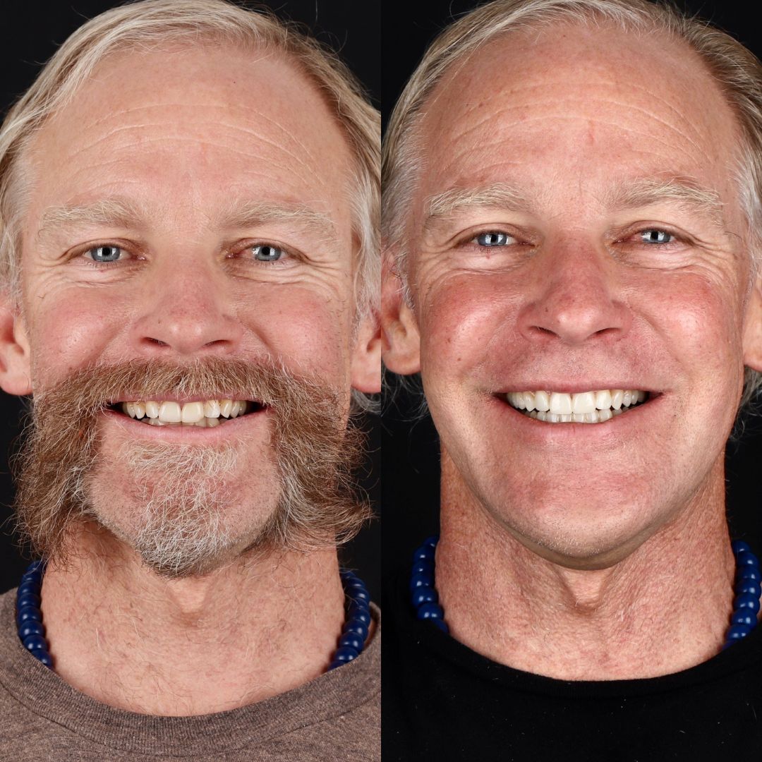 Before and After Image - Slideshow