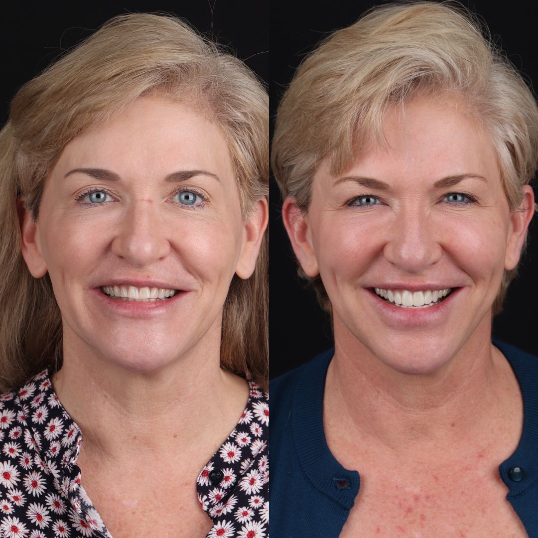 Before and After Image - Slideshow